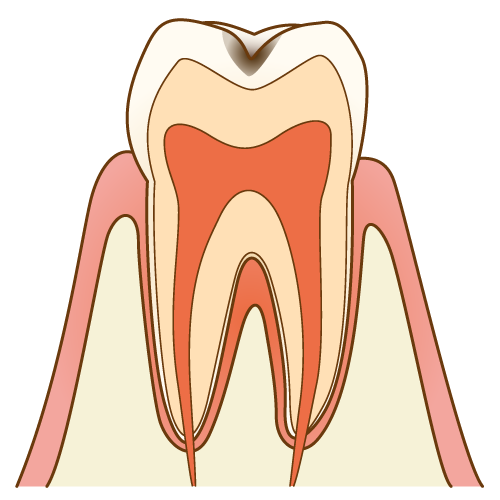 むし歯治療