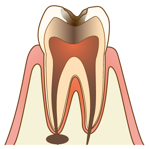 むし歯治療